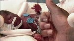VIDEO:  New study finds premature births on the rise.