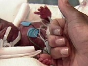 Government Study: Premie Births Rising