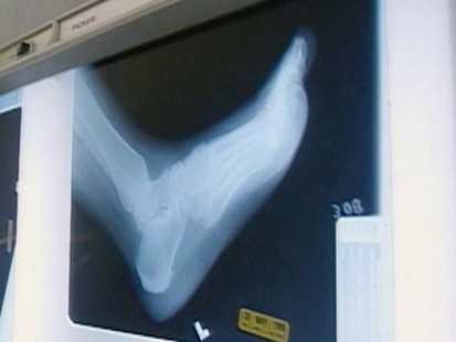 VIDEO: Could Your Shoes Be a Pain in the Foot?