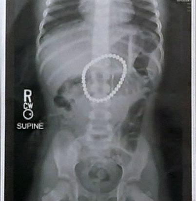 abc payton bushnell xray ss jp 120305 ssv Magnet Toys: What To Do if Your Child Swallows a Magnet
