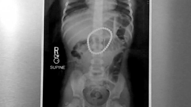 PHOTO: A 3-year-old girl continues to recover in the hospital Friday after accidentally swallowing 37 high-powered rare earth Buckyball magnets.