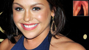 PHOTO Rachael Ray said she had surgery in July to remove a benign cyst on her vocal cords.