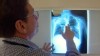 PHOTO: Two hospitals in Sacramento and Solano County, California, have reached out to parents of 25 babies who many have been exposed to tuberculosis in the hospitals' neonatal intensive care units.
