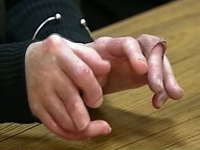 Video: Study confirms rare outbreak of Scleroderma in South Boston.