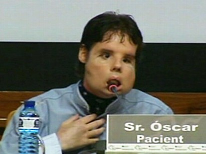 VIDEO: Spanish man, 31, undergoes the worlds first full-face transplant.