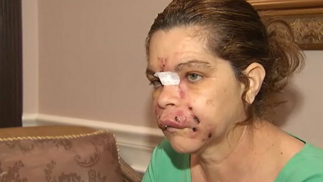 PHOTO: Isabel Gonzalez remains in the hospital after receiving facial rejuvenation treatments from an unlicensed spa owner.