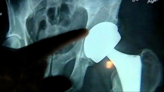VIDEO: DePuy hip recalled; patients report severe pain, doctors fear metal shavings.