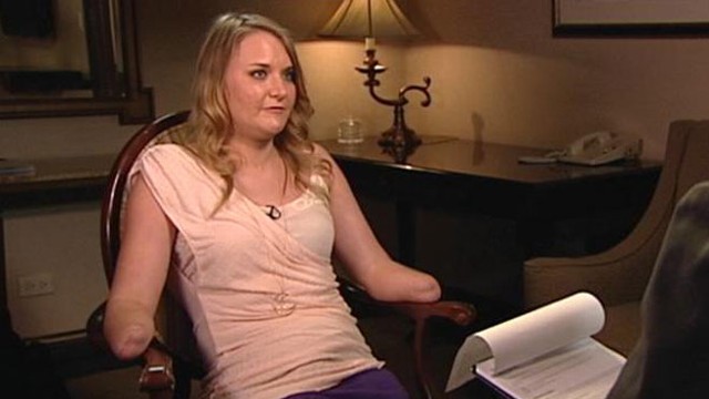 Aimee Copeland Gets Bionic Hands Abc News