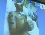 VIDEO: A Polish man underwent the 27-hour transplant just three weeks after a workplace accident. 