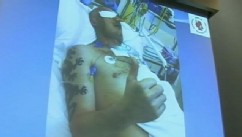 VIDEO: A Polish man underwent the 27-hour transplant just three weeks after a workplace accident. 