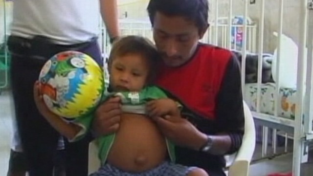 VIDEO: Doctors in Peru plan to remove partially formed fetus absorbed by brother.