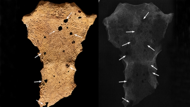 VIDEO: 3,200-year-old skeletal remains of a young man found in a tomb in Africa harbor the oldest evidence yet of cancer in humans.
