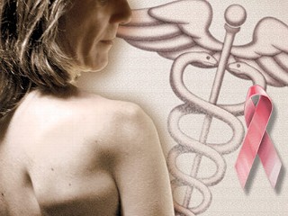 Breast Cancer