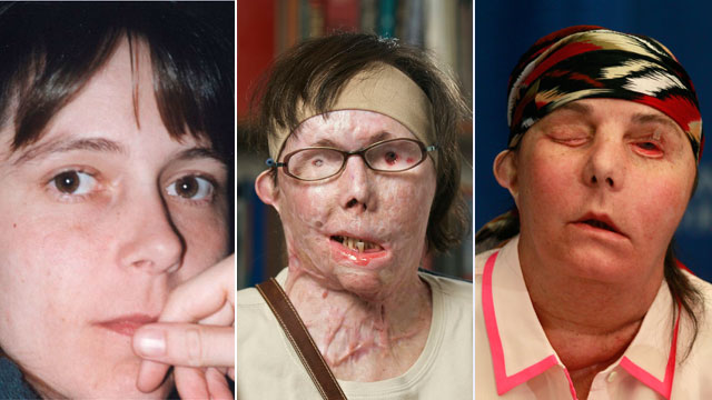 PHOTO: Carmen Blandin Tarleton, of Thetford, Vt, underwent a transplant in February after a 2007 attack in which her estranged husband doused her with industrial strength lye, burning more than 80 percent of her body.