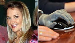 PHOTO: Aimee Copeland received two new bionic hands this week from Touch Bionics in Ohio.