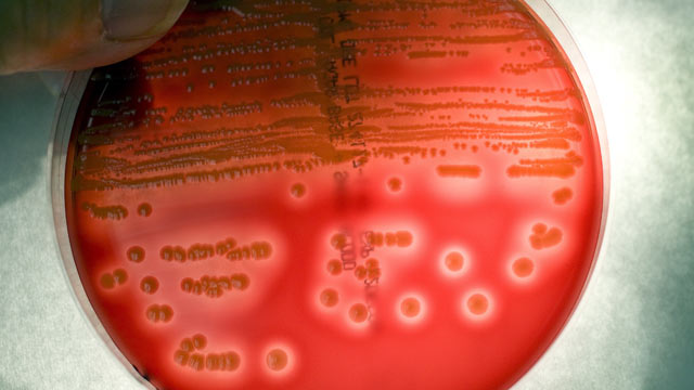 PHOTO: Methicillin-resistant Staphylococcus aureus colonies from a patient grow in a blood agar plate. The white areas around the colonies indicate where MRSA infection is attacking and destroying the red blood cells.