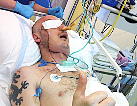 Man Saved by Face Transplant