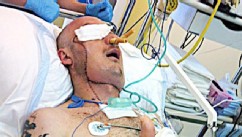 Man Saved by Face Transplant