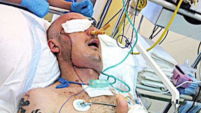 Man Saved by Face Transplant