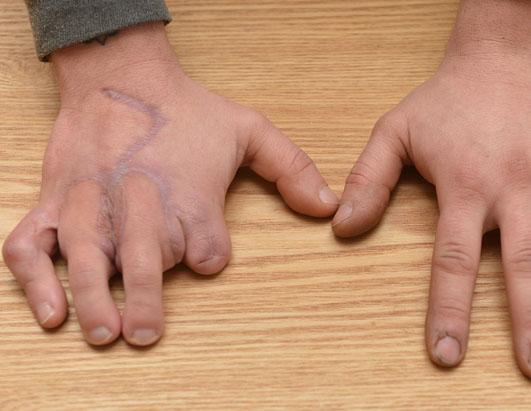 Man's Missing Fingers Replaced by Toes