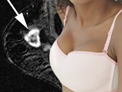 breast cancer bra