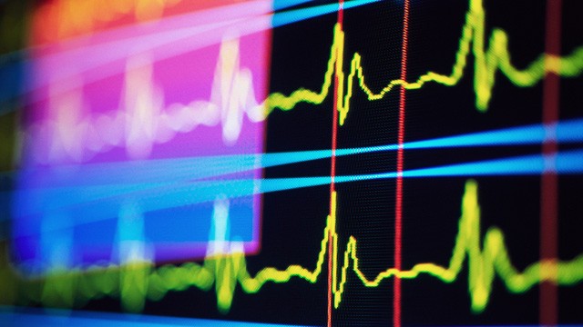 PHOTO: EKG