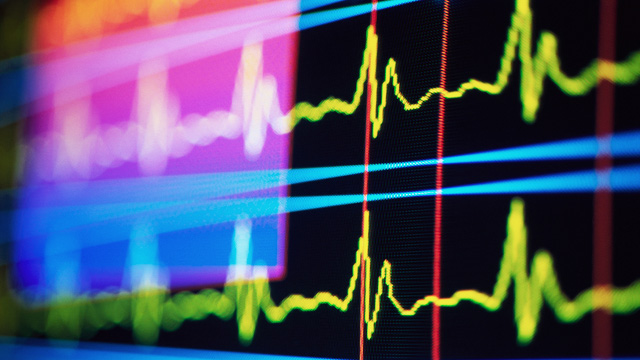 PHOTO: EKG