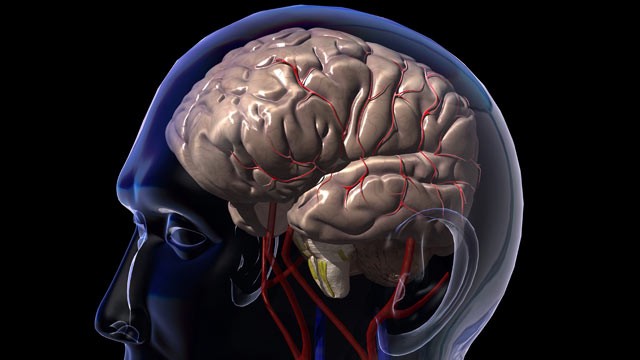 PHOTO: Mini strokes or TIAs temporarily cut off blood flow to the brain, typically causing problems for an hour or two.