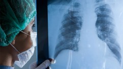 PHOTO: Chest x-ray