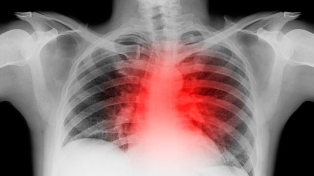 PHOTO: A cardiologist in England gained some international attention when he used an unconventional procedure -- a shot of basic alcohol -- to stop an unusual heart rhythm in an elderly patient.