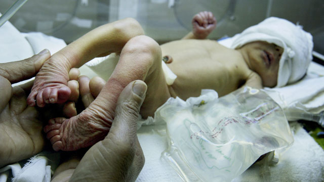 PHOTO: Hanan Ali, seven days old and weighing 2 kilos, was born premature with birth defects at the Al Alwya Pediatric hospital in this November 15, 2003 file photo from Baghdad, Iraq.