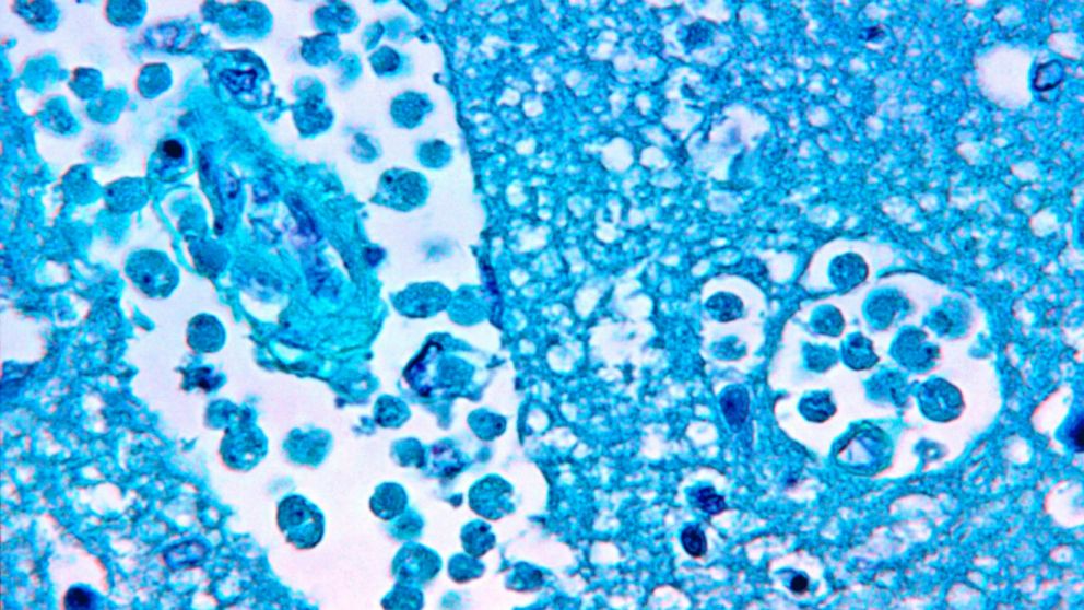 PHOTO: This photomicrograph of a brain tissue specimen magnified 500 percent depicts the cytoarchitectural changes associated with a free-living, Naegleria fowleri, amebic infection.