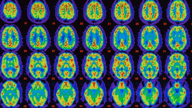 PHOTO: PET scans comparing Alzheimer's sufferer's brain with healthy brain.