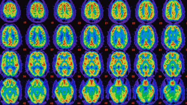 PHOTO: PET scans comparing Alzheimers sufferers brain with healthy brain.