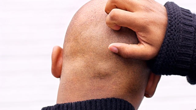 PHOTO: The cause of itchiness has been discovered by scientists.