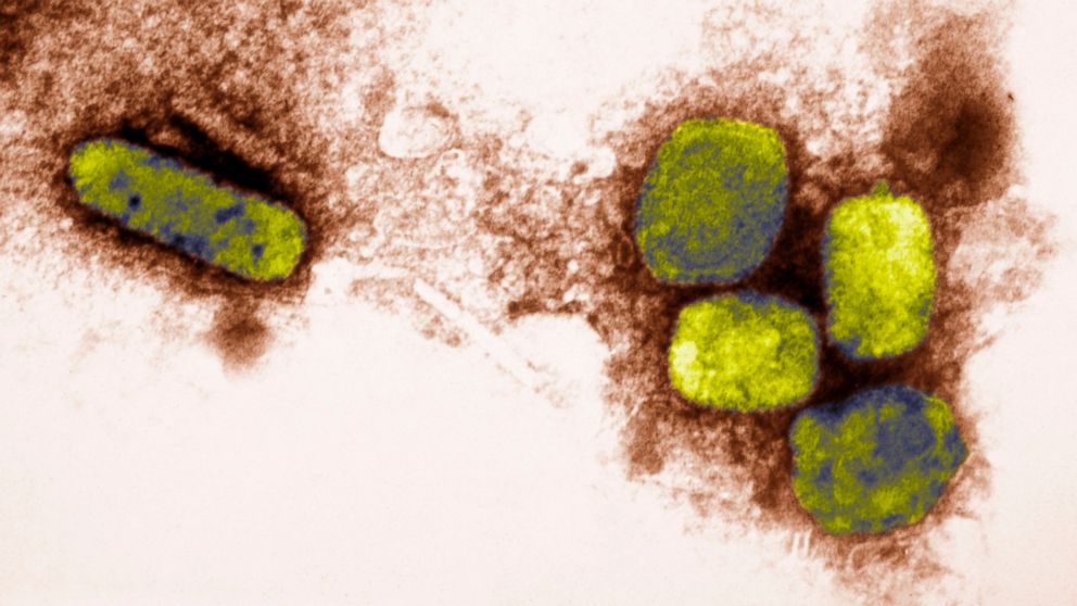 PHOTO: Smallpox virus is seen at 65,000x magnification in an undated electron micrograph.