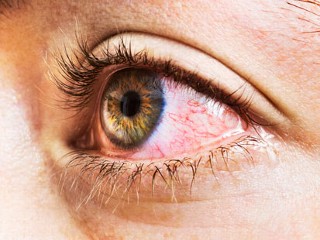The ABCs of Allergies