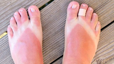 gty_sunburn_88547206_ll_120709_wb.jpg