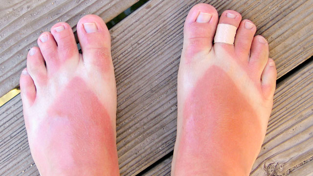 PHOTO: Sunburn