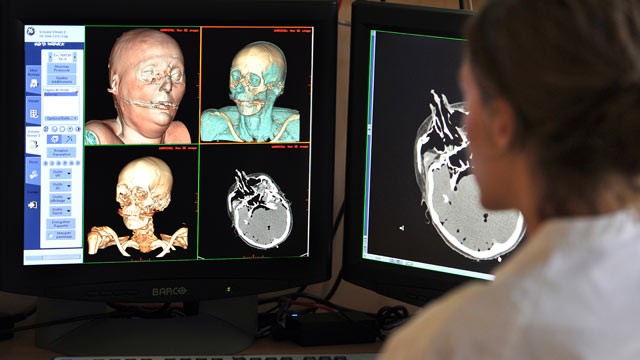 PHOTO: A radiologist looks at the scans of a reconstituted corpse in 3D in order to proceed in a virtual autopsy on September 20, 2011 at the Medical Imagery Departement of the Timone Hospital in Marseille, France.