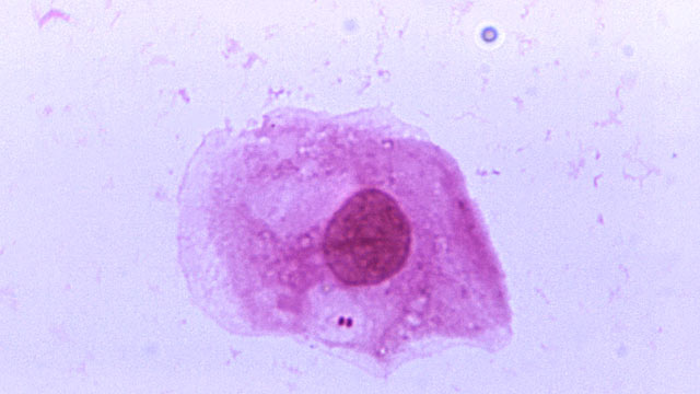 PHOTO: A photomicrograph shows Neisseria meningitidis recovered from the urethra of an asymptomatic male.