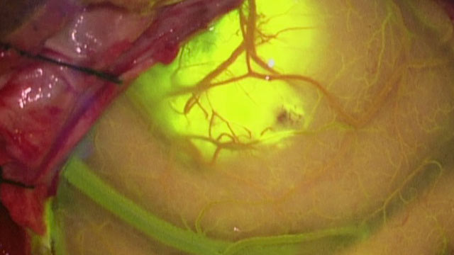 PHOTO: Using a special, glowing dye and equipment, surgeons can remove brain tumors more accurately than ever before.