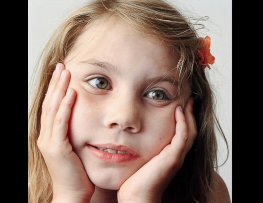 Amazing how congenital facial nerve palsy got love