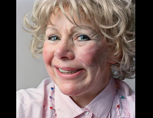 Got your congenital facial nerve palsy big cock