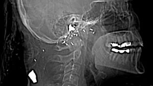 Photo: bullet in head
