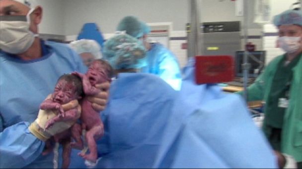 Hospital Welcomes Second Set Of Rare Mono Mono Twins Abc News