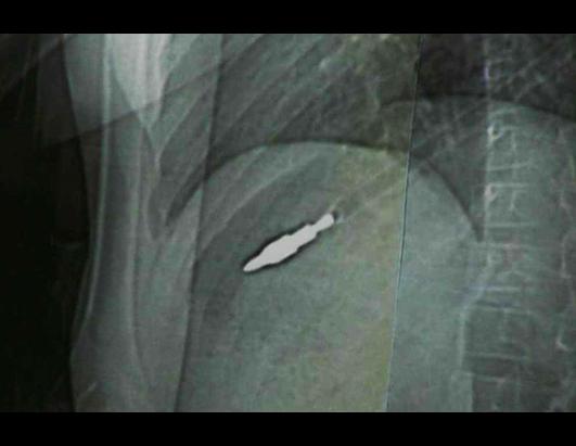 X-Rays: Little Girl Swallows 37 Magnets