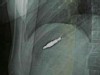X-Rays: Little Girl Swallows 37 Magnets