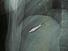 X-Rays: Little Girl Swallows 37 Magnets