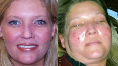 Daphne Carroll says she was burned by a laser facial.